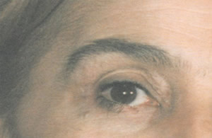 eye after treatment