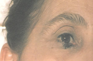eye before treatment