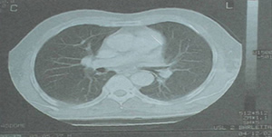 lungs after treatment