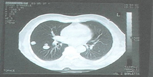 lungs before treatment