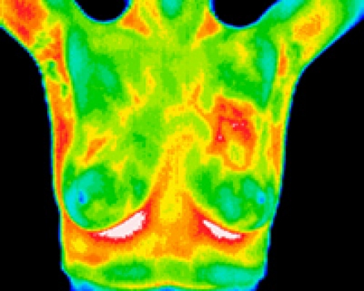 Breast Thermography - Advanced Thermal Imaging of West 