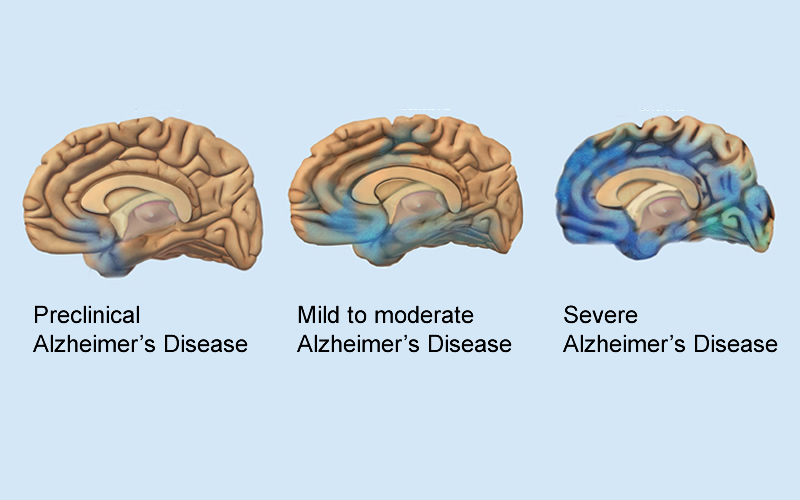 Dementia and Alzheimer's Disease | Foundation for Alternative and ...
