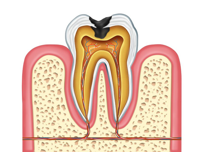 What Really Causes Cavities Foundation For Alternative And Integrative Medicine