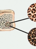 Illustration of health bone and bone with osteoporosis