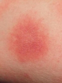 bull's-eye rash on arm