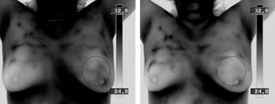 b/w breast thermal images