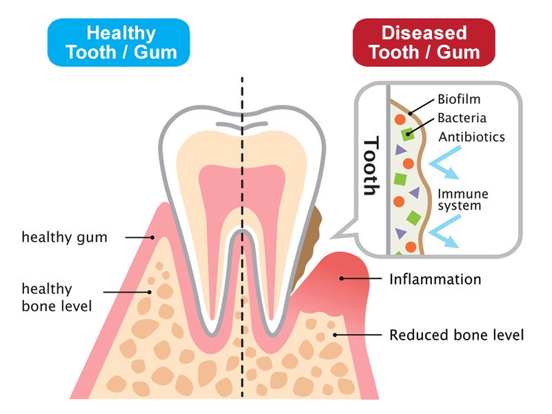 illustration showing healthy pink gum around tooth compared with diseased brown and receding gum