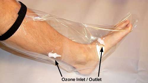 leg inside plastic bag with ozone connections