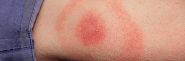 bull's-eye rash on arm