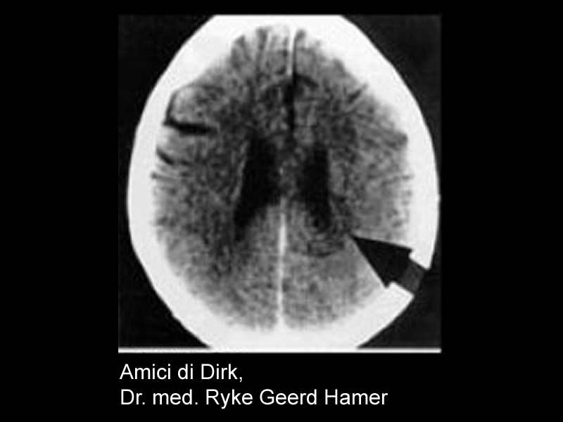 black and white image of brain CT scan; arrow points to area with concentric rings on left side