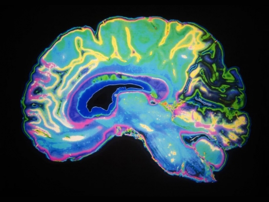 MRI scan of human brain, artificially colored with blues, pinks, yellows, and greens