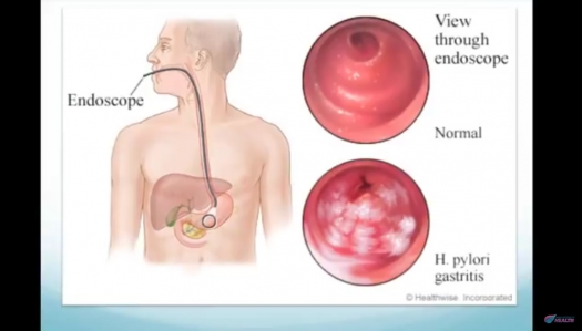 illustration of endoscope showing normal and abnormal results