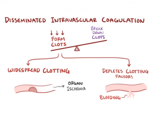 Illustration showing DIC as a condition that leads to both widespread clotting and bleeding.