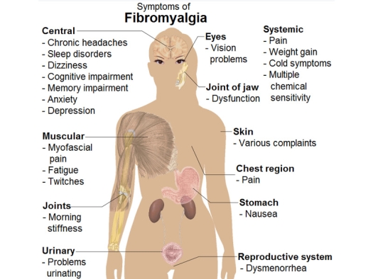 Illustration of female human body with common signs and symptoms of fibromyalgia.