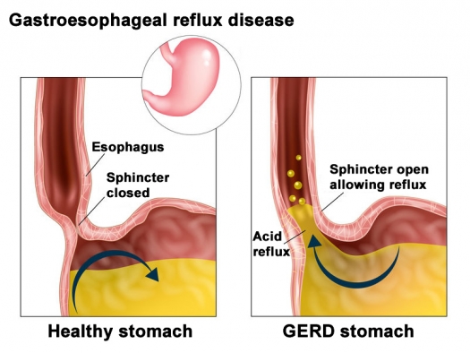 illustration of healthy stomach with sphincter closed and GERD stomach with sphincter open allowing acid reflux