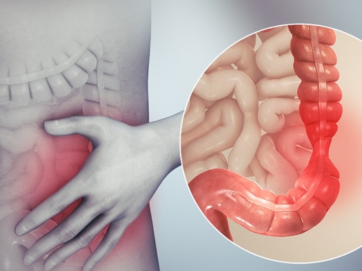 illustration of person holding their side with an enlargement image of an inflamed intestine