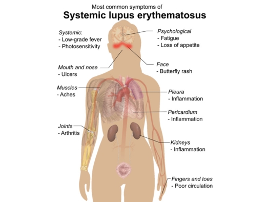 Illustration of common signs and symptoms of systemic lupus erythematosus.