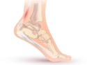 illustration of a human foot with pain in the achilles tendon, just above the heel