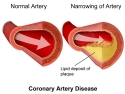 illustration of normal, free-flowing artery and narrowing of artery with plaque buildup