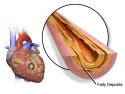 Illustration of heart and enlargement of artery made narrow by fatty deposits.