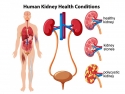 illustration of kidney and bladder; healthy kidney and kidney stones