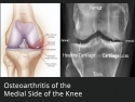 Osteoarthritis of the Medial Side of the Knee: illustration of knee joint showing bones, cartilage, and narrowed joint space
