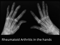 X-ray of hands showing fingers bent at awkward angles due to Rheumatoid Arthritis