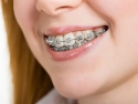 young woman wearing braces on teeth