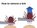illustration showing how to grab a tick on the skin with tweezers and pull up to remove
