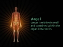 Figure of human; text says: "Stage 1: cancer is relatively small and contained within the organ it started in."